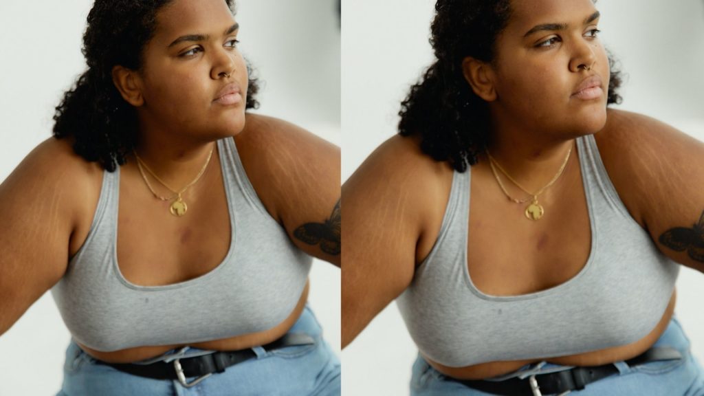 Prevention of Stretch Marks on the Breast